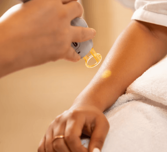 Laser hair removal procedure