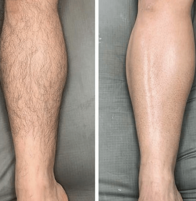 Advanced laser treatment