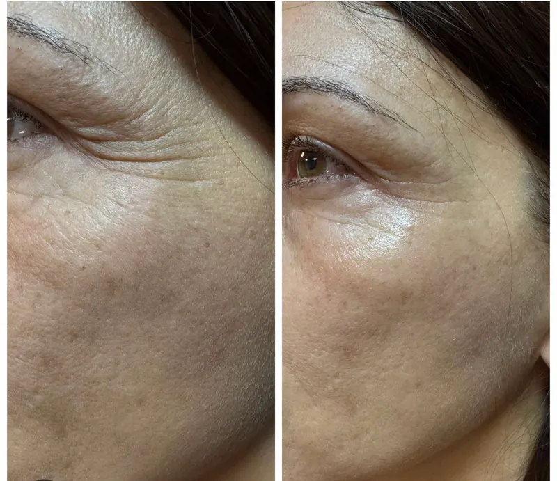 HIFU non-surgical body contouring