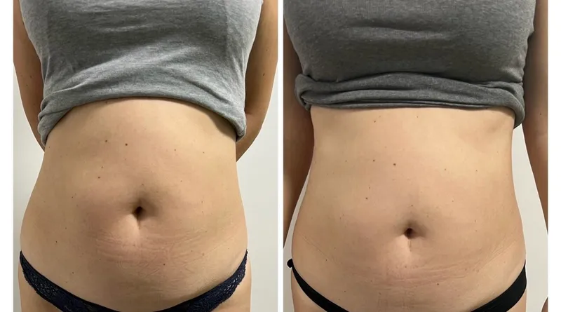 HIFU skin tightening procedure