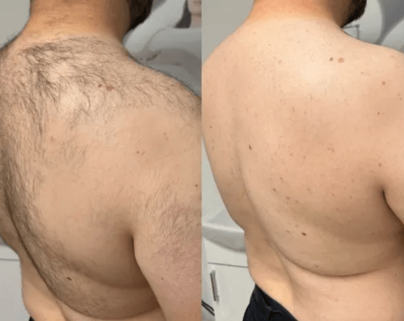 Laser hair removal treatment procedure