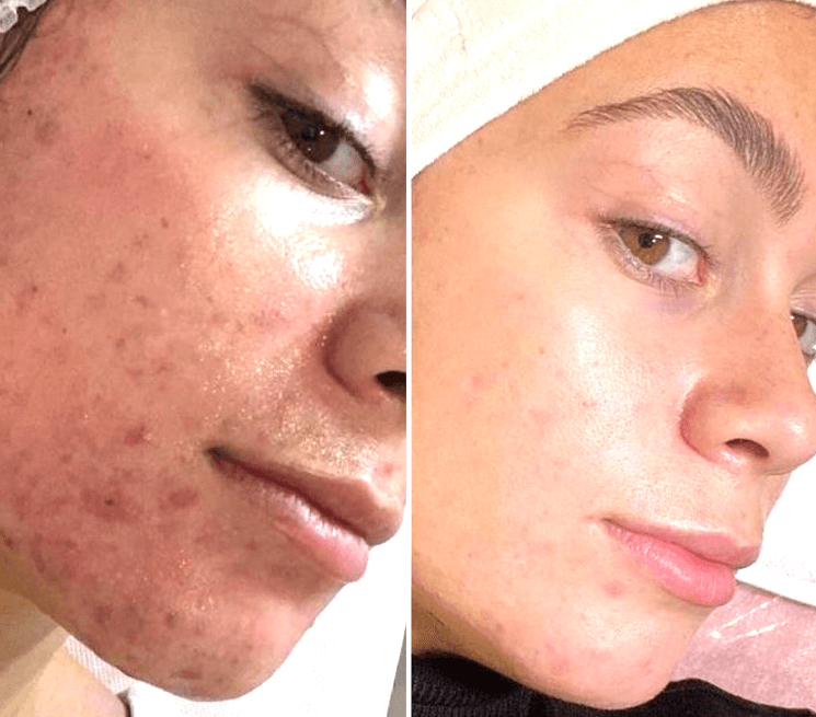 Beauty treatment process